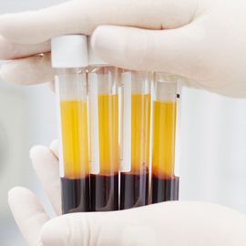 Blood plasma samples in test tubes for analysis in a plasma proteomics study.  
