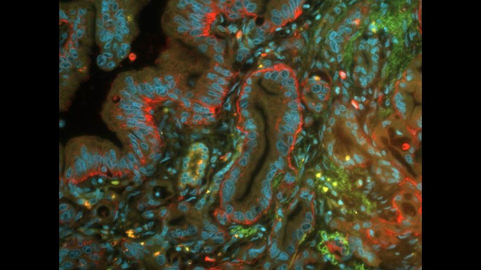 A topographical map of pancreatic cancer cells, with Antithrombin shown in red.