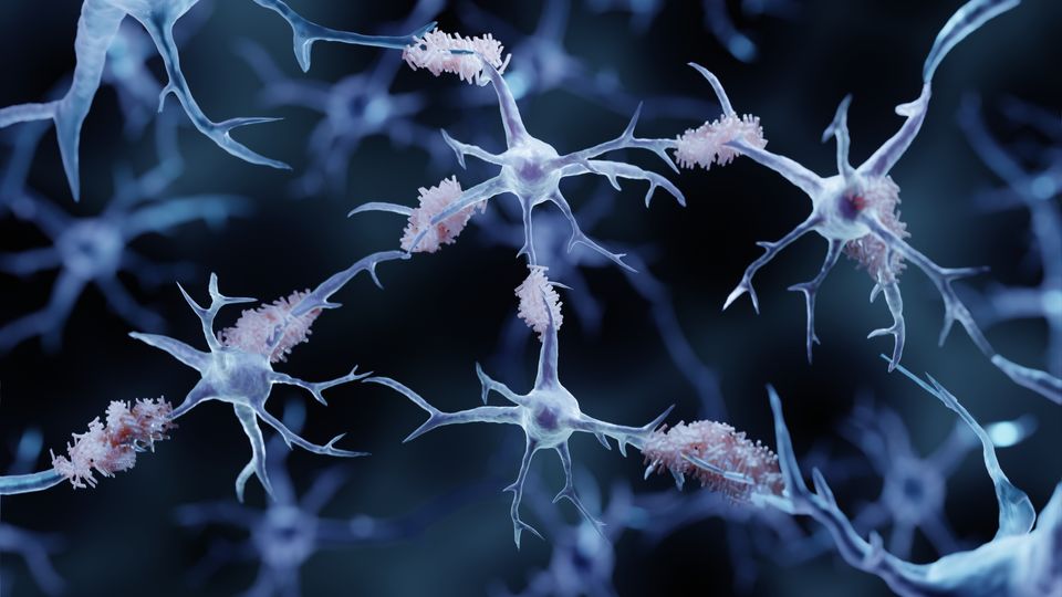 3D illustration of neurons with amyloid plaques, representing Alzheimer’s disease pathology.
