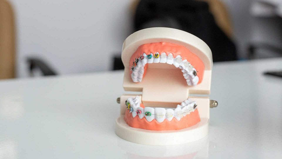 Dental model with braces on a white table, used for studying oral microbiome and hygiene.