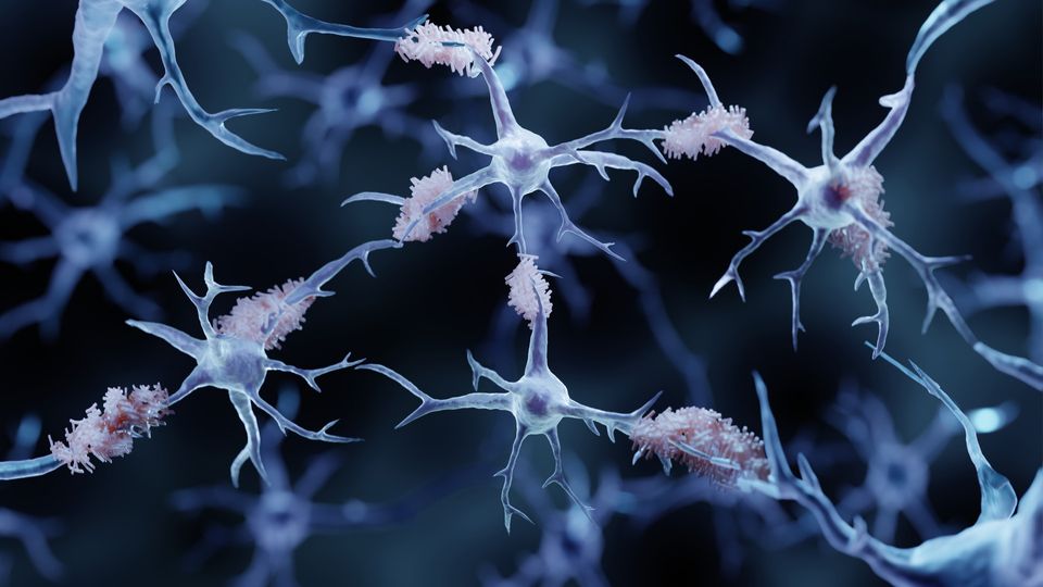 Neurons with amyloid plaques, illustrating Alzheimer’s disease.