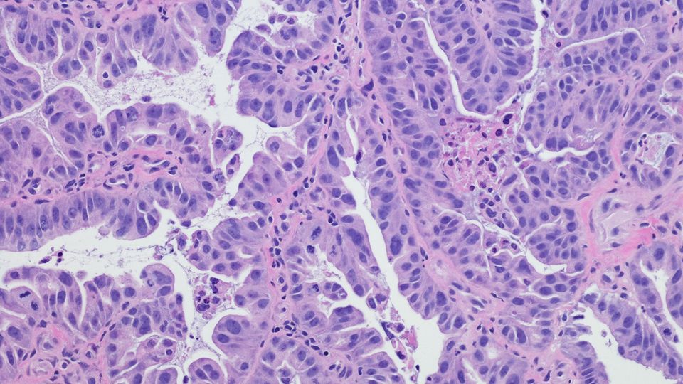 Immunohistochemistry microscopic image of cancerous tissue.