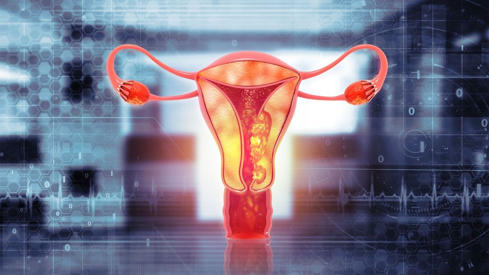 Digital illustration of ovarian cancer within the female reproductive system.