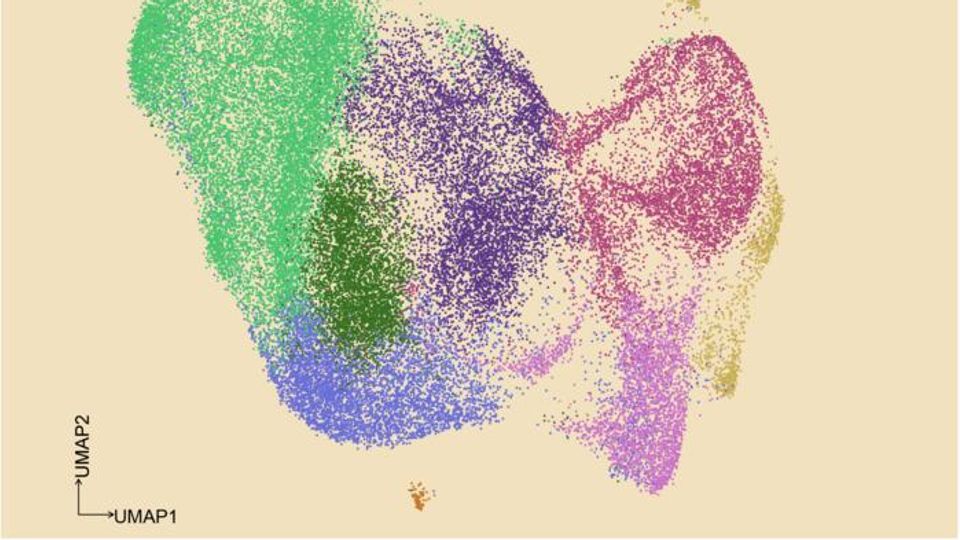 A UMAP graphical depiction of 45,963 cancer cells from patients whose chronic lymphocytic leukemia has transformed into a more aggressive type.