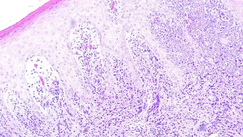 Histology slide showing tumor microenvironment cells under a microscope, illustrating insights for cancer treatment strategies.