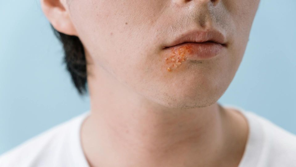 Close-up of a man's lips with visible cold sore outbreak caused by herpes simplex virus.