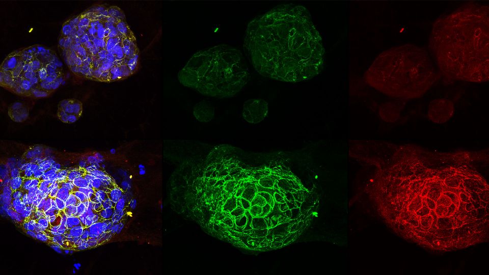 This image shows patient derived tumor organoids before (top) and after treatment (bottom). The colors show the activation of pathways related to cell differentiation in cancer stem cells. Shortly after these images were taken, the cancer stem cells spontaneously collapsed.