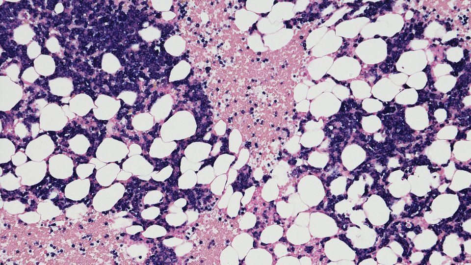 Microscopic view of bone marrow cells used in epigenetic analysis for liquid biopsy applications.