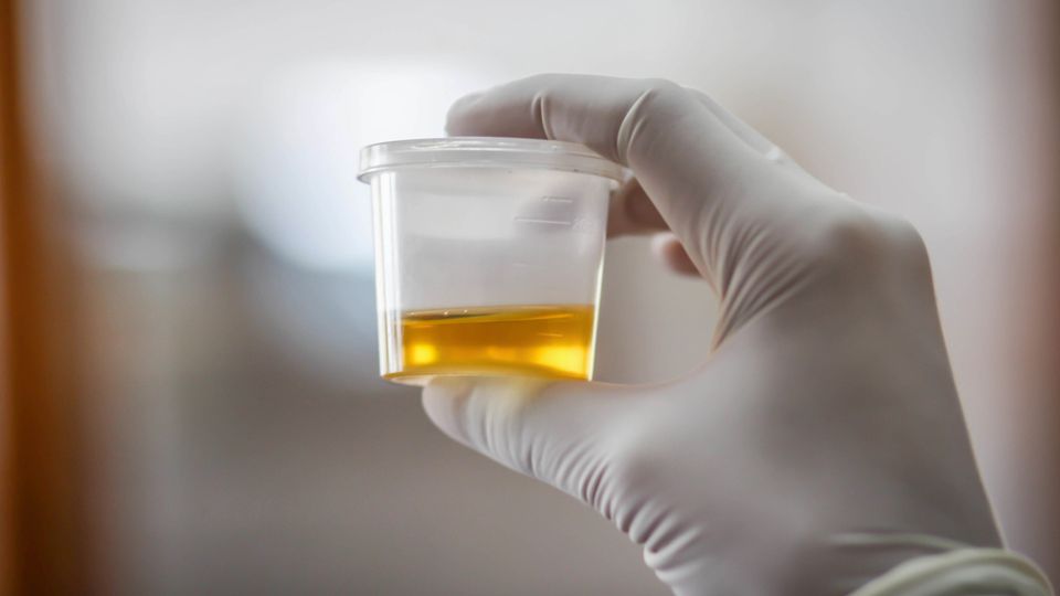 Gloved hand holding a urine sample container for lupus biomarker testing.