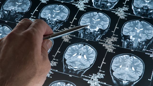 Doctor pointing at brain scan images showing structural changes linked to neurodegeneration. 