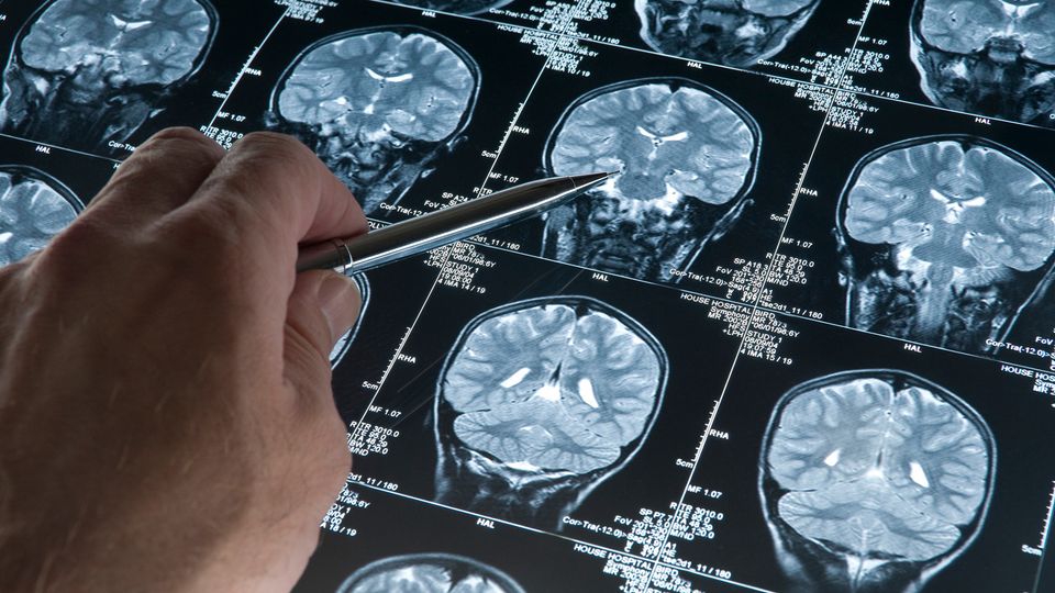 Doctor pointing at brain scan images showing structural changes linked to neurodegeneration.