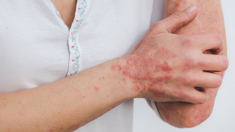 Close-up of a person’s arm and hand with red, scaly psoriasis patches on the skin.