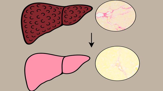 Treatment with Lawsone converts a liver with fibrosis into a healthy liver. 
