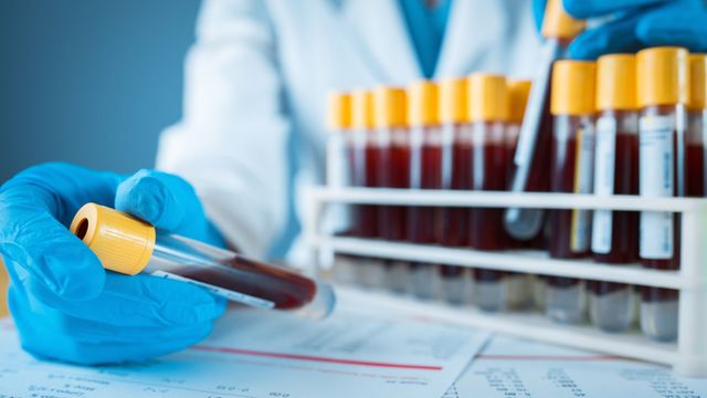 Laboratory technician preparing blood samples for Alzheimer's study. 