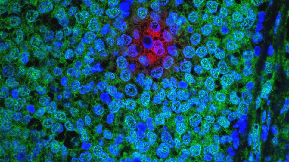 Treatment-resistant breast cancer cells are illuminated in red amongst other cancer cells in green and blue.