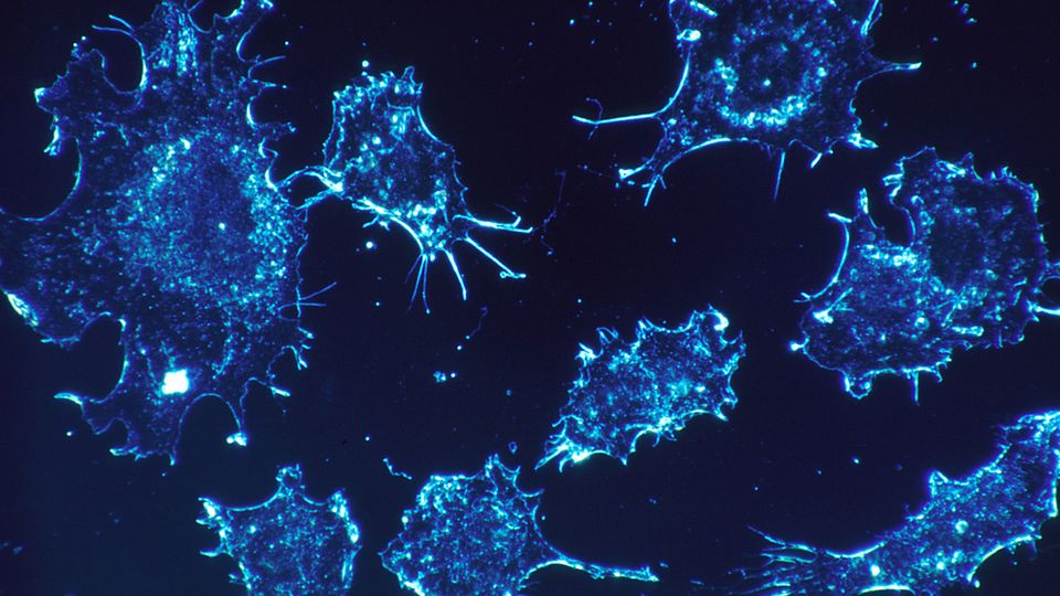 Cancer cells from connective tissue illuminated in a microscopy image.