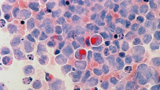 Acute myeloid leukemia cells under a microscope. 