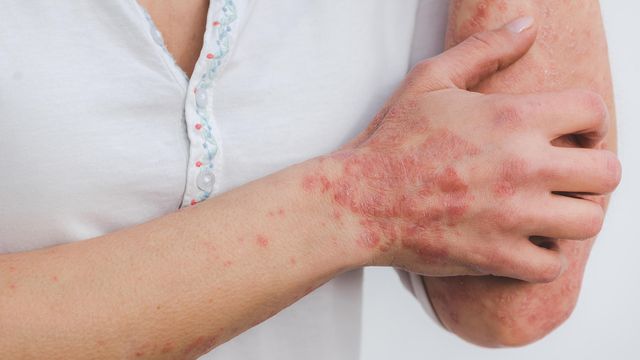 Close-up of red, scaly psoriasis patches on a person’s hand, wrist and elbow. 