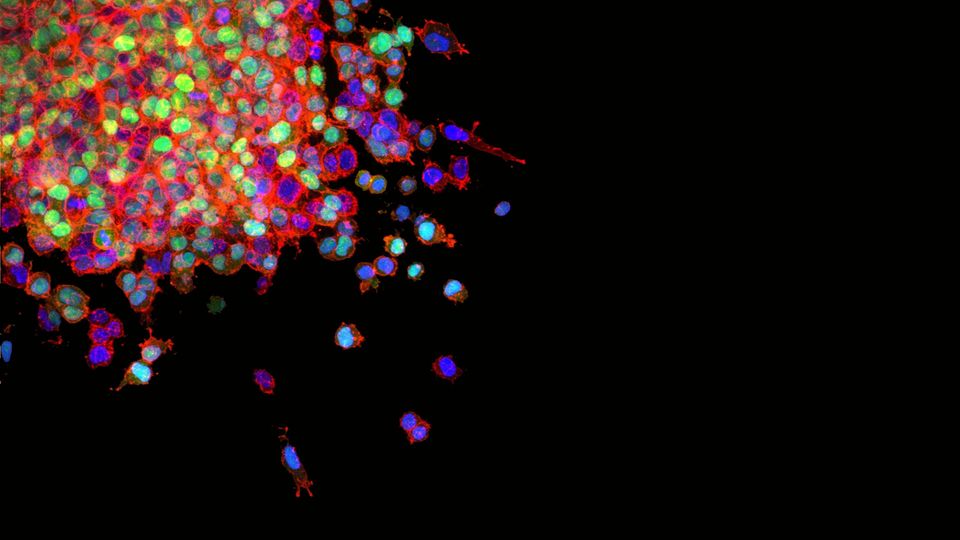 Lung cancer cells as they metastasize.