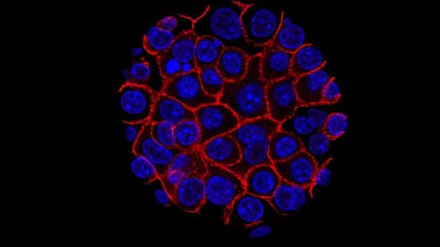 Pancreatic cancer cells, with nuclei in blue and membranes in red. 