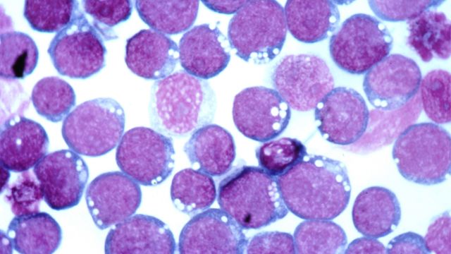 Epstein-Barr virus stained with Hematoxylin and eosin. 