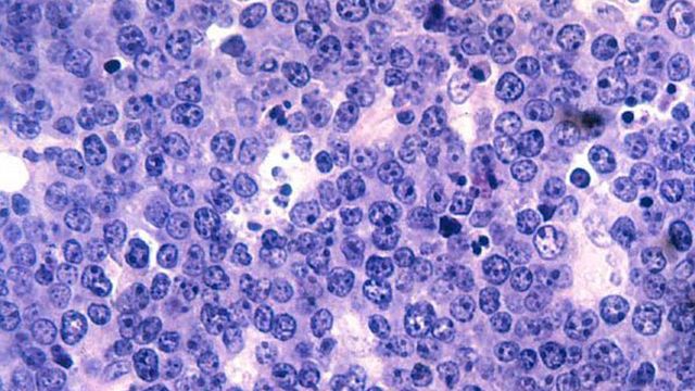 B-cell lymphoma cells under the microscope. 