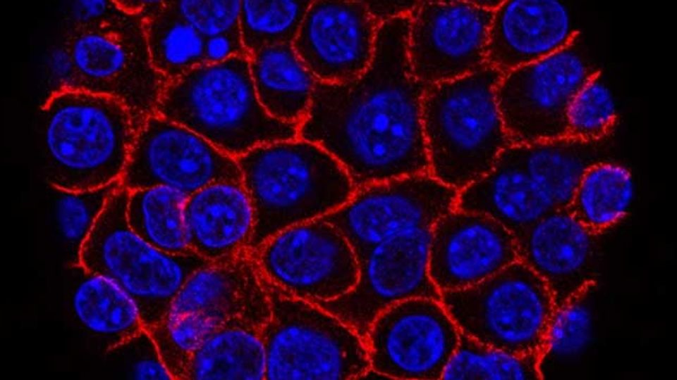 Pancreatic cancer cells, their nuclei labelled in blue and membranes in red.