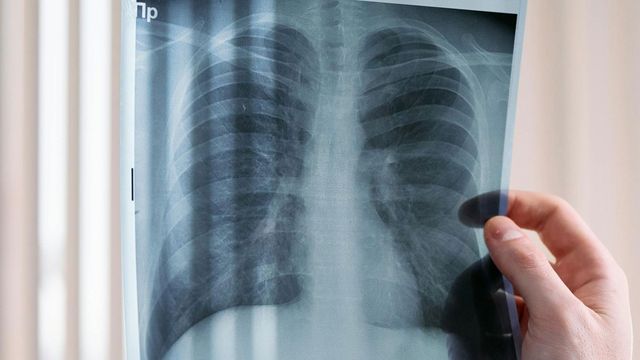Lung Cancer Screening in the US Misses Most Patients