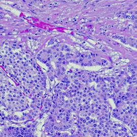 Microscopic view of stained cancer cells used in research for cell line development. 