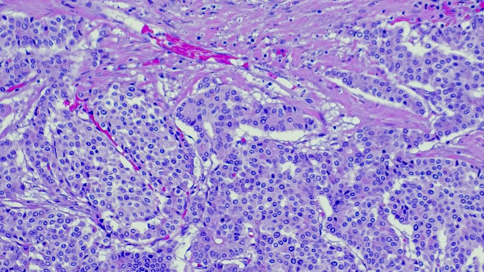 Microscopic view of stained cancer cells used in research for cell line development.