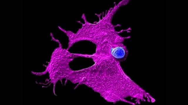 Fluorescent image of a CAR-NKT immune cell engaging a pancreatic tumor cell, illustrating targeted solid-tumor attack. 