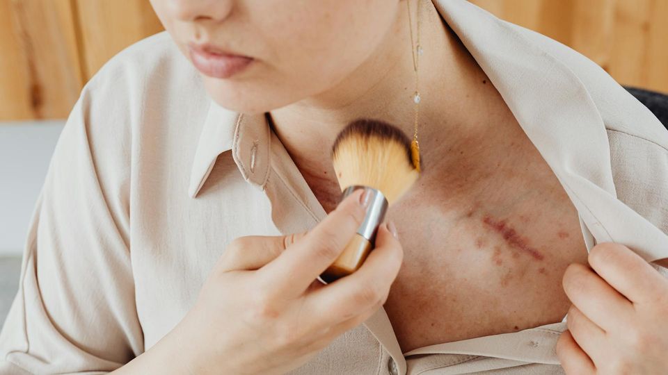 Person revealing a scar, highlighting research focused on healing wounds without scar tissue.