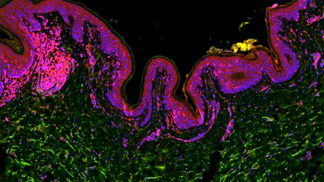 Environmental Chemicals Emerge as Skin Condition Risk Factor