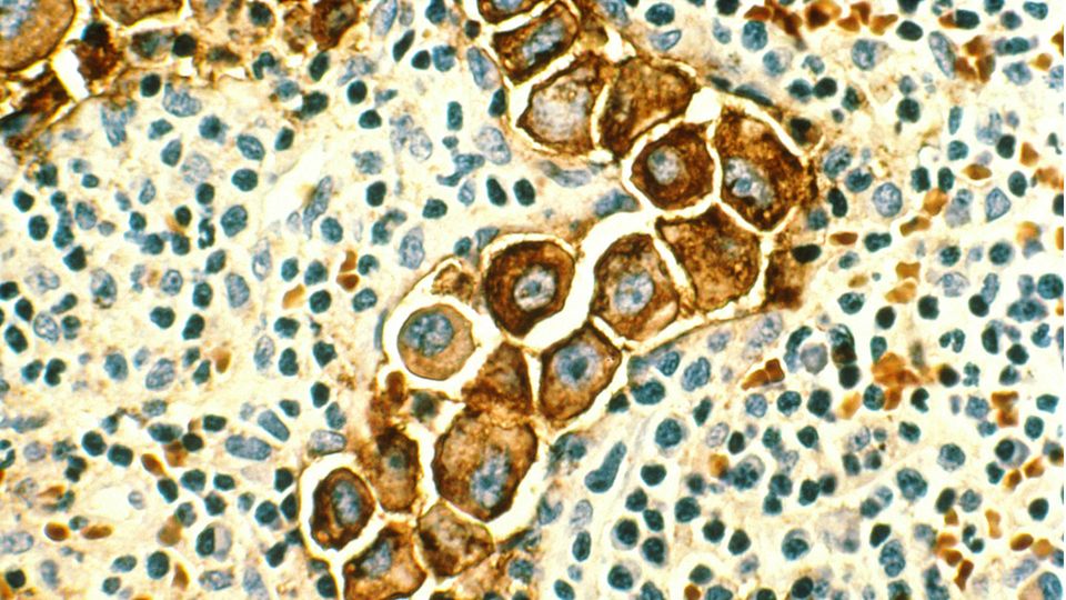 Enlarged breast cancer cells sit within smaller lymph node cells.