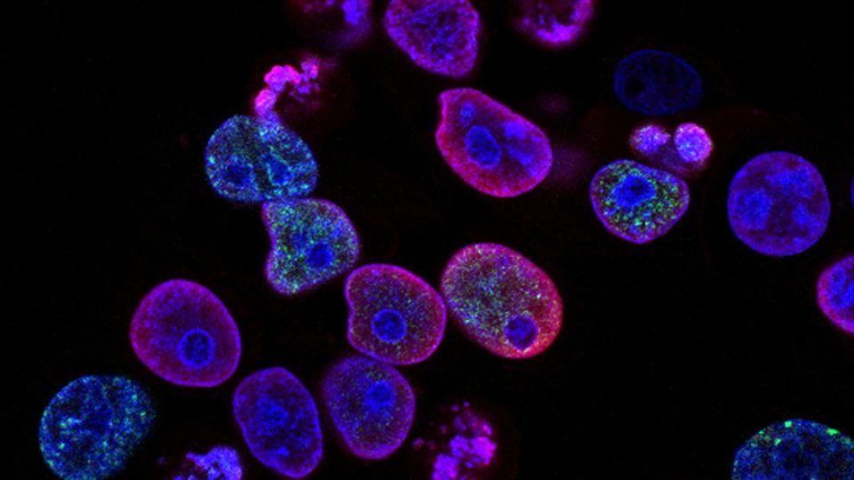 Colorectal cancer cells, some with distended nuclei, imaged in pink, purple, blue and green.