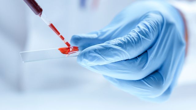 Close up of a scientist's hand adding a blood sample to a microscope slide. 
