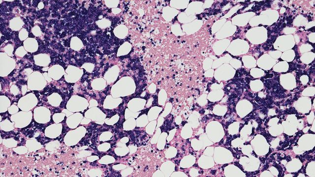 Microscopic view of bone marrow tissue used in liquid biopsy for cancer diagnostics. 