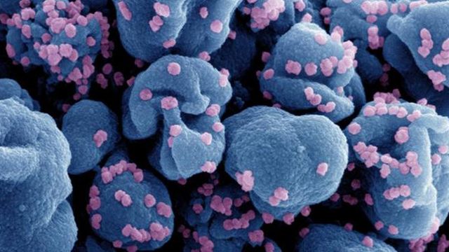 Microscopic view of SARS-CoV-2 virus particles (pink) infecting host cells (blue). 