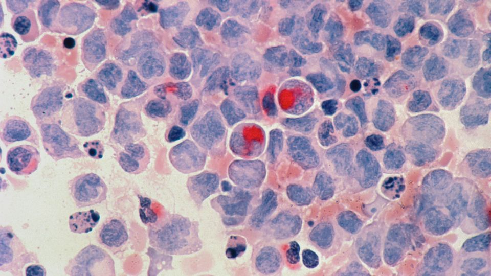Microscopic view of acute myeloid leukemia cells.