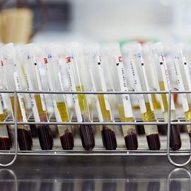 A rack of test tubes containing separated blood plasma and cells, suitable for use in droplet digital PCR (ddPCR) analysis. 