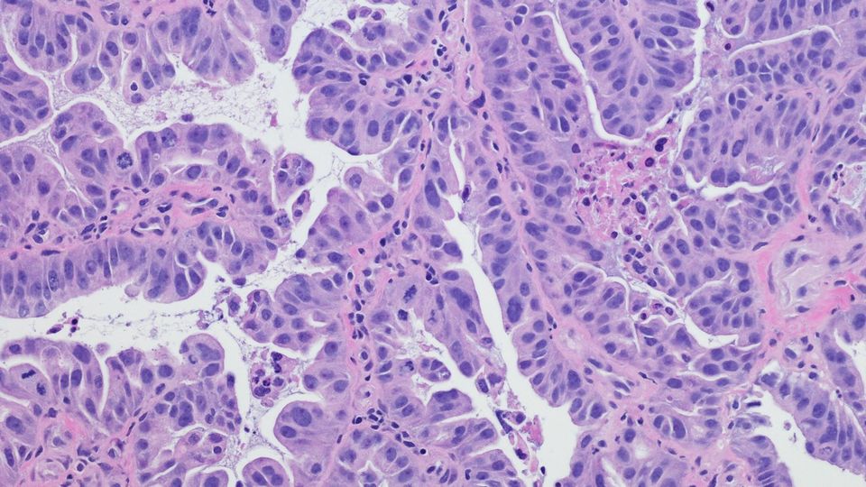 Histopathology slide showing densely packed cancer cells with abnormal nuclei and glandular patterns.