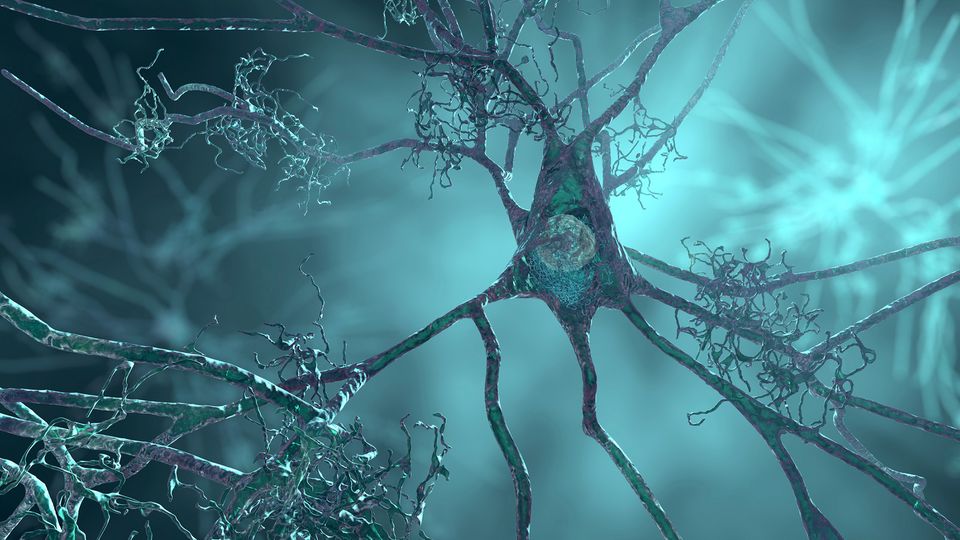 3D illustration of brain neurons with damaged connections, representing Alzheimer’s disease.