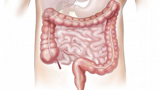 Medical illustration of the human digestive tract highlighting gut inflammation in the intestines. 