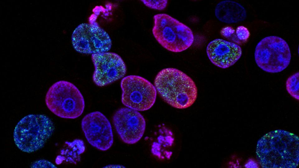 Fluorescent microscopy image showing colon cancer cells associated with tumor metastasis.