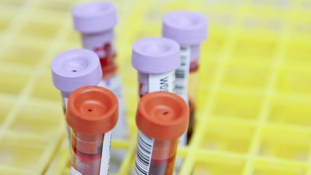 Blood sample tubes in a lab rack. The tubes have barcodes and red or purple lids and are sitting in a yellow rack. 