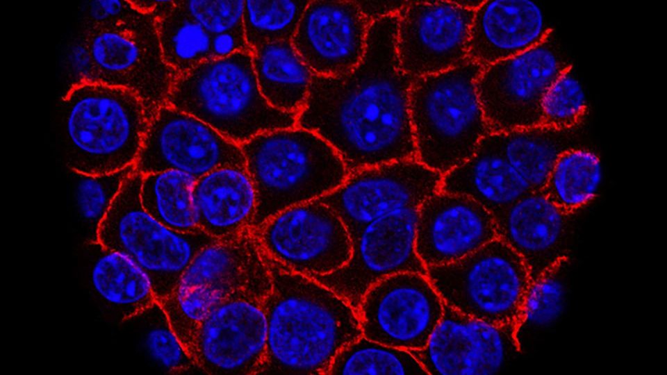 Fluorescent microscopy image showing pancreatic cancer cells with highlighted cellular structures.