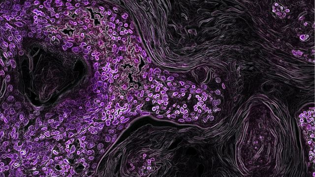 Purple-labelled KRAS-driven lung cancer cells grow and push against healthy cells. 