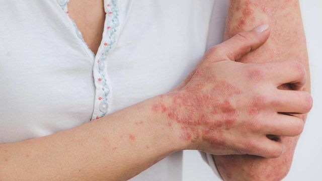 Red, scaly psoriasis patches visible on a person’s arm and wrist. 
