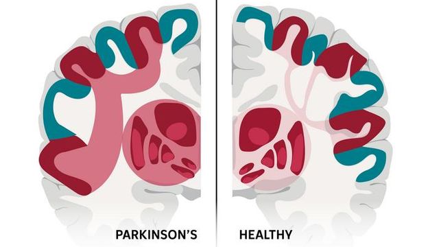 A side-by-side comparison of healthy and Parkinson's brains, showing significant differences in the SCAN network. 
