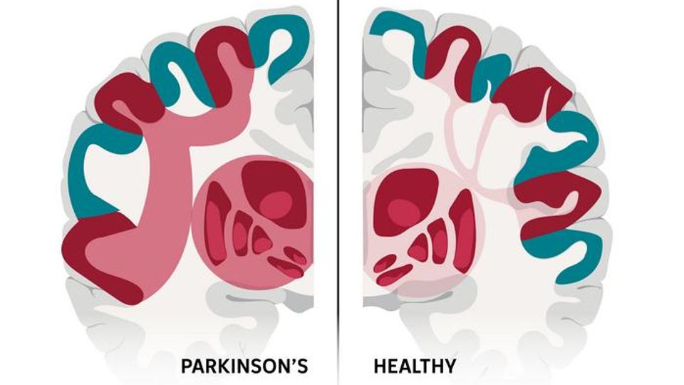 A side-by-side comparison of healthy and Parkinson's brains, showing significant differences in the SCAN network.